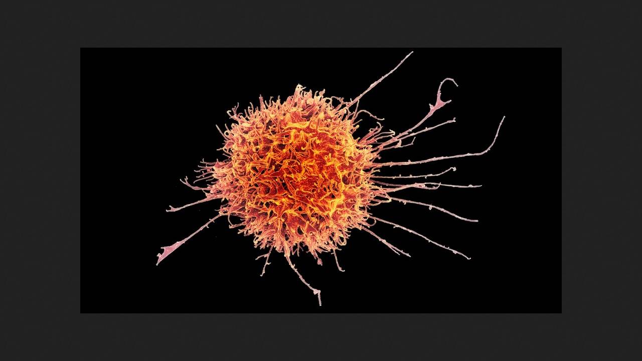 CAR-T Therapy for Autoimmune Diseases Has New Side Effect