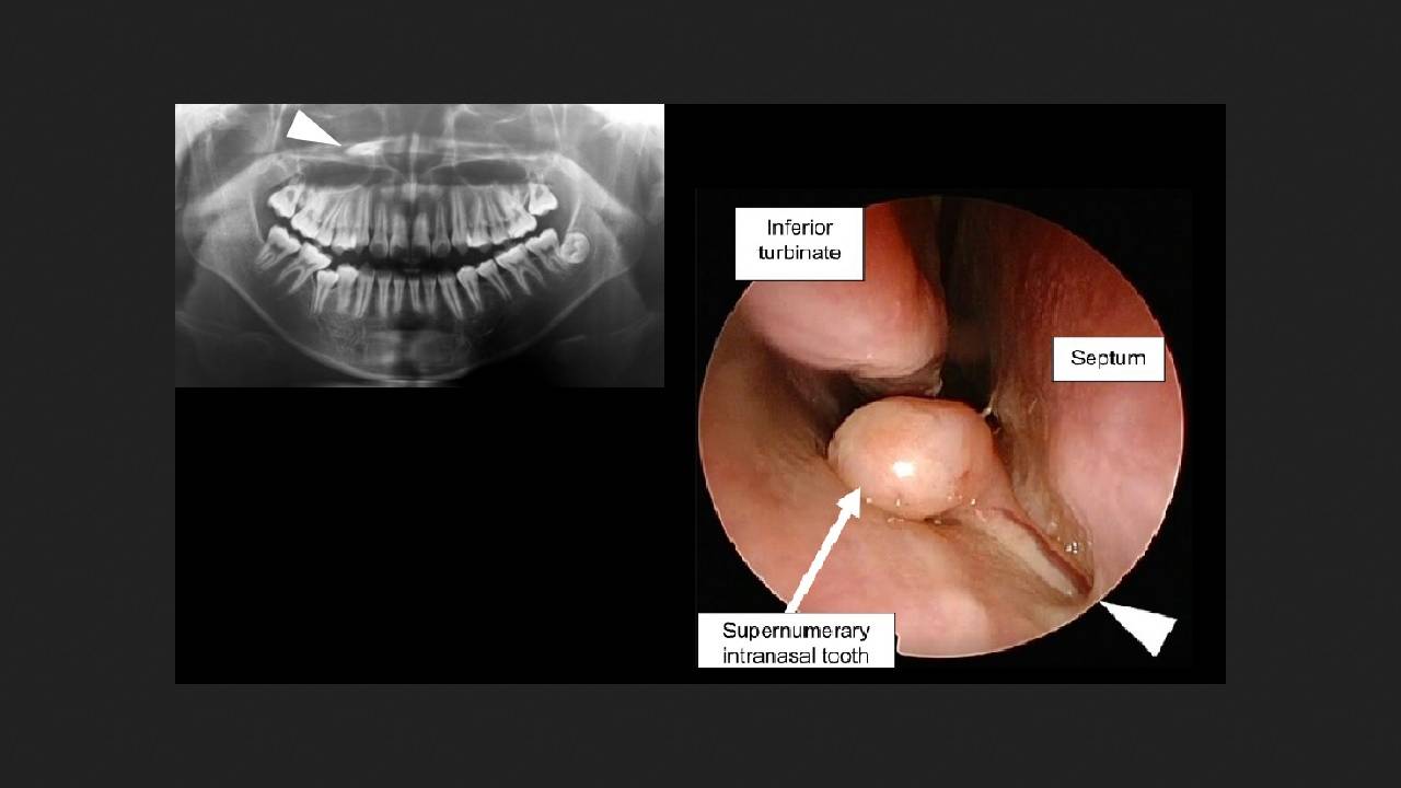 Japanese surgeons remove tooth from child's nose
