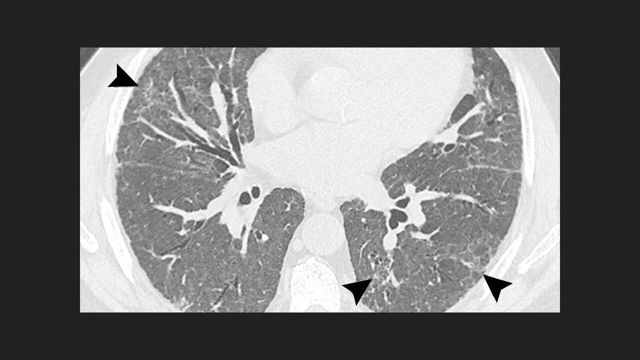 Radiologists urge to do CT scans after Covid only for patients with long-term symptoms