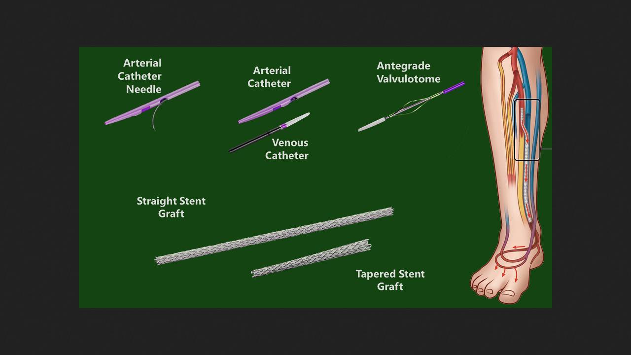 Система катетерної артеріалізації вен надовго врятувала від ампутації ніг
