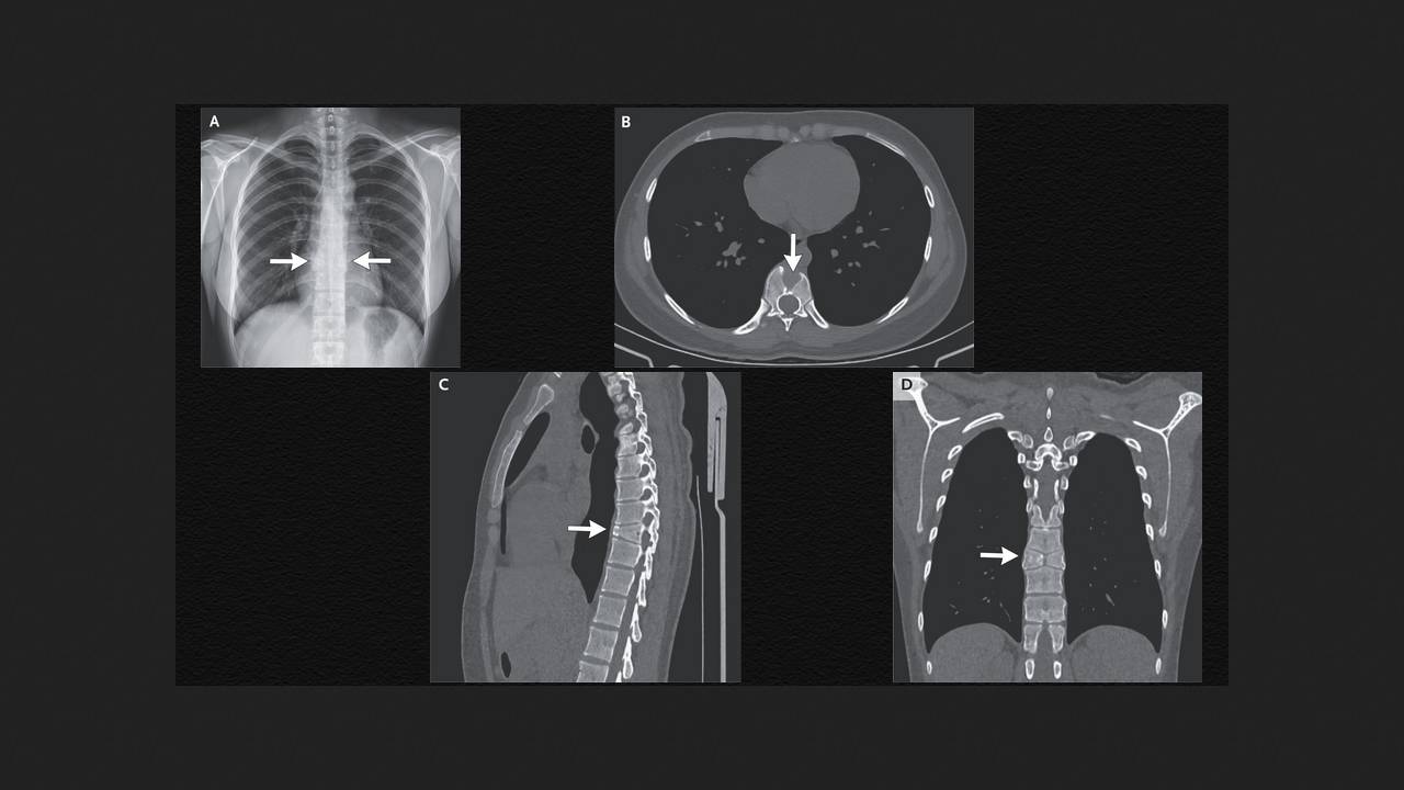 A butterfly vertebra was accidentally found in a Chinese woman with a cold.