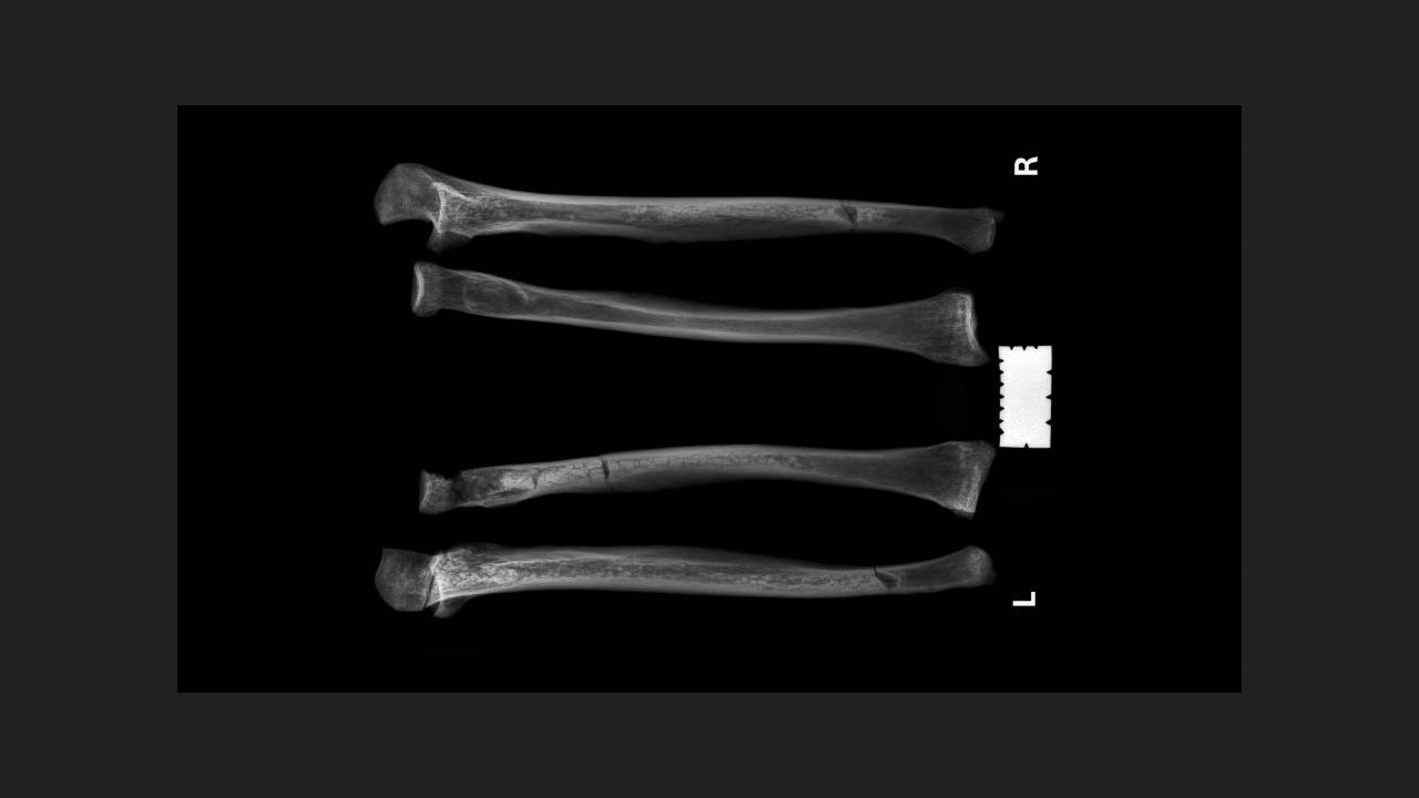 Средневековый британец выжил после ампутации кисти