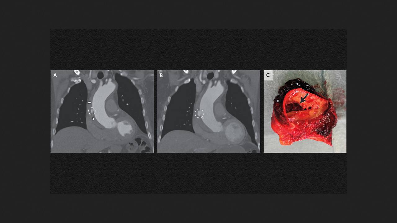 Нидерландцу удалили гематому в стенке аорты