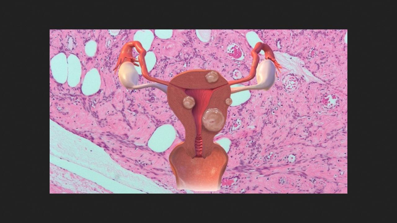 Uterine fibroids increase the risk of developing cardiovascular diseases